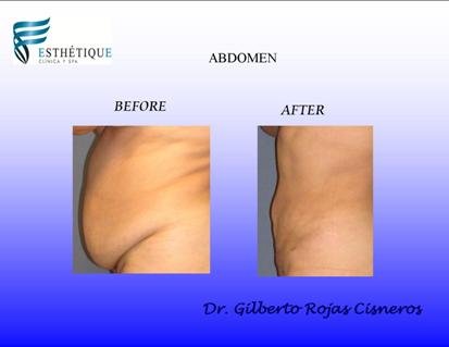 Tummy Tuck Before and After Costa Rica